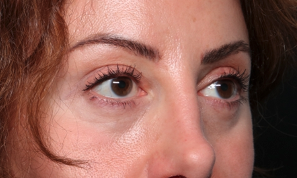 Blepharoplasty and Brow Lift Before & After Patient #34363